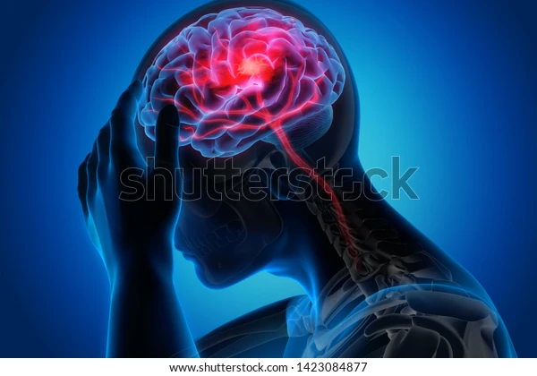 man-headache-stroke-3d-illustration-600w-1423084877