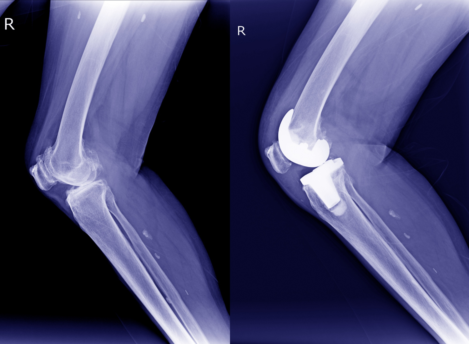 x-ray-right-osteoarthritis-knee-oa-post-operation-total-knee-arthroplasty-tka-vi