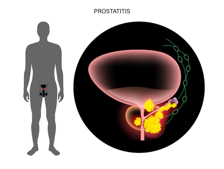 prostate-cancer-concept_206049-4083